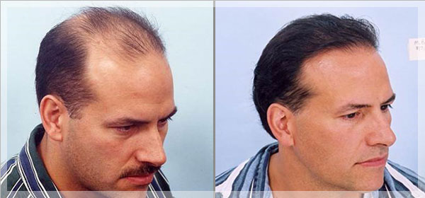 regrow hair after surgery